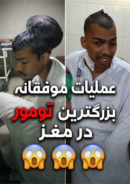 بزرگترین تومور مغزی جهان